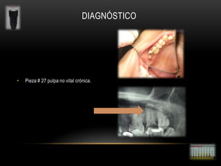 DIAGNÓSTICO

•

Pieza # 27 pulpa no vital crónica.

 