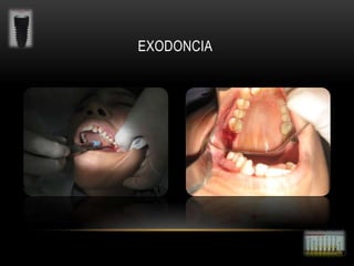 EXODONCIA

 