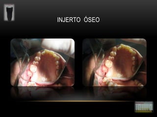 INJERTO ÓSEO

 