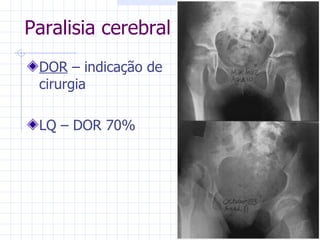 DOR  – indicação de cirurgia LQ – DOR 70% Paralisia cerebral 