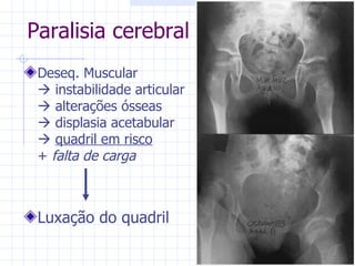 Deseq. Muscular   instabilidade articular   alterações ósseas   displasia acetabular    quadril em risco +  falta de carga Luxação do quadril Paralisia cerebral 