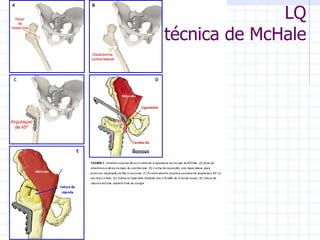 LQ técnica de McHale 