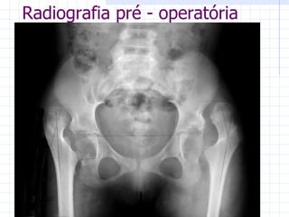 Radiografia pré - operatória 