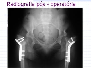 Radiografia pós - operatória 