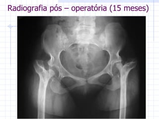 Radiografia pós – operatória (15 meses) 
