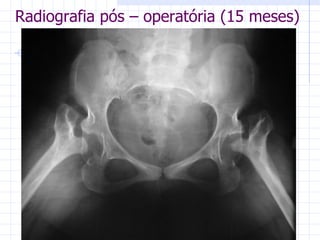 Radiografia pós – operatória (15 meses) 