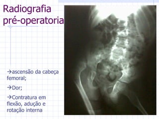 Radiografia pré-operatoria  ascensão da cabeça femoral; Dor; Contratura em flexão, adução e rotação interna 