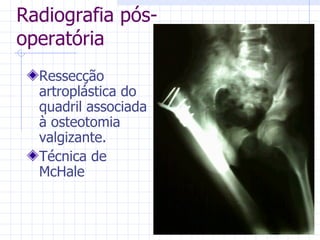 Radiografia pós-operatória Ressecção artroplástica do quadril associada à osteotomia valgizante. Técnica de McHale 