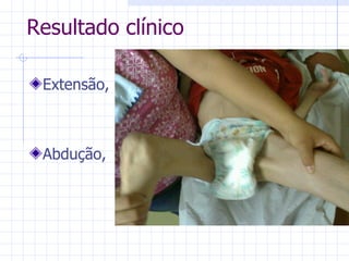 Abdução, Resultado clínico Extensão, 