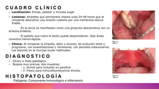 C U A D R O C L Í N I C O
• Localización: Encías, paladar y mucosa yugal
• Lesiones: Ampollas que permanece intacta unas 24-48 horas que al
romperse descubren una erosión cubierta por una membrana blanca
friable.
En la encía se manifiestan como una gingivitis descamativa con un
eritema brillante.
El epitelio que cubre la lesión puede desprenderse: deja áreas
conectivo hemorrágicas.
• Clínica: Al romperse la ampolla, dolor y escozor, de evolución lenta y
progresiva, con exacerbaciones y remisiones, con periodos estacionarios.
Las lesiones en la mucosa ocular habituales.
• Clínico e histo-patológico.
• Biopsia muy precisa, dos muestras:
- 1. formol para inclusión en parafina
- 2. fresco para inmunofluorescencia directa.
D I A G N O S T I C O
H I S T O P A T O L O G Í A
Patógenia: Componente Inmunológico e inflamatorio
 