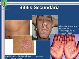 Sífilis1906: Wasserman, Neisser e Brock – anticorpos lipoídicos(6)                                                                      (7)Gleydson Abreu