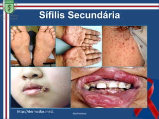 Sífilis1910: Paul Erlich – SalvarsanGuerra do Salvarsan: Alemanha anti-semita, religiosos fanáticosLiberação do medicamento(8)                                                                             (9)Gleydson Abreu