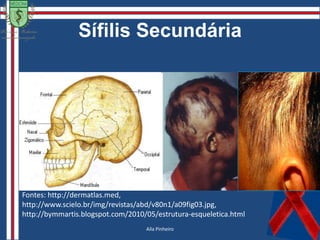 SífilisDados Epidemiológicos: LACEN – 2560 testes: VDRL 176 positivos Teste VDRL, HIV, entre outros Gleydson Christian
