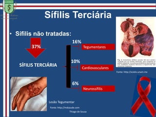 SífilisTreponemaSistema LinfáticoEtiopatogeniaPenetraçãoDisseminaçãoSistêmicaResposta da Defesa LocalComplexos Imunes Circulantes que se Depositam em Vários Órgãos Referência:  Anais Brasileiros de Dermatologia Vol 81 Número 2 - 2006Camila Maria