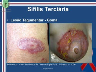 Sífilis AdquiridaManifestações Clínicas:Recente: Sífilis Primária