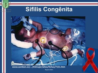 Sífilis SecundáriaAs sífilis secundárias se distribuem pelo tronco, face, área peribucal, sulcos nasogenianos e na palmoplantar.Lesões descamativas  -  colar descamativo ao longo da periferia das lesões;Lesões mucosas  - na cavidade oral, regiões genitais e perianal.Aíla Pinheiro