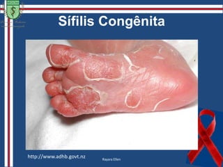 Sífilis SecundáriaAíla PinheiroReferência:  Fotos- Anais Brasileiros de Dermatologia Vol 81 Número 2 – 2006http://www.medicinageriatrica.com.br/2008/01/page/7/