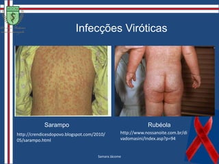 Sífilis SecundáriaMicropoliadenopatia generalizadaA sintomatologia geral é discreta e incaracterística, com:Mal-estar, astenia, anorexia, febre baixa, cefaléia, meningismo, artralgias, mialgias, periostite, faringite, rouquidão, hepatoesplenomegalia, síndrome nefrótica, neurite do auditivo e iridociclite.Lesões do secundarismo podem ser sucedidas pelo “colar de Vênus”.Alopecia em clareiraAíla Pinheiro