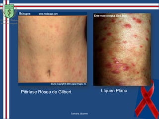 Sífilis SecundáriaAíla PinheiroFontes: http://dermatlas.med, http://www.scielo.br/img/revistas/abd/v80n1/a09fig03.jpg, http://bymmartis.blogspot.com/2010/05/estrutura-esqueletica.html