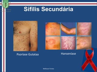 Sífilis SecundáriaVARIANTES DA SÍFILIS SECUNDÁRIAAíla PinheiroReferência:  Fotos- Anais Brasileiros de Dermatologia Vol 81 Número 2 - 2006