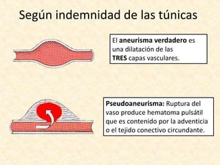 Según indemnidad de las túnicas
El aneurisma verdadero es
una dilatación de las
TRES capas vasculares.
Pseudoaneurisma: Ruptura del
vaso produce hematoma pulsátil
que es contenido por la adventicia
o el tejido conectivo circundante.
 