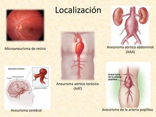 Localización
Microaneurisma de retina
Aneurisma cerebral
Aneurisma aórtico torácico
(AAT)
Aneurisma aórtico abdominal
(AAA)
Aneurisma de la arteria poplítea
 