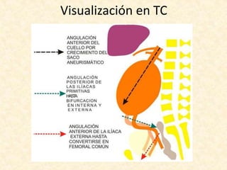 Visualización en TC
 