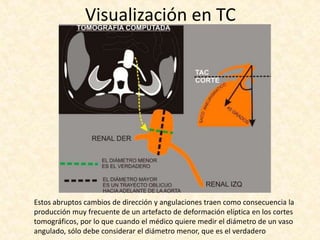 Estos abruptos cambios de dirección y angulaciones traen como consecuencia la
producción muy frecuente de un artefacto de deformación elíptica en los cortes
tomográficos, por lo que cuando el médico quiere medir el diámetro de un vaso
angulado, sólo debe considerar el diámetro menor, que es el verdadero
Visualización en TC
 