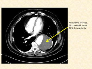 Aneurisma torácico.
10 cm de diámetro
60% de trombosis
 