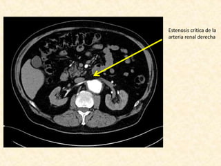 Estenosis crítica de la
arteria renal derecha
 