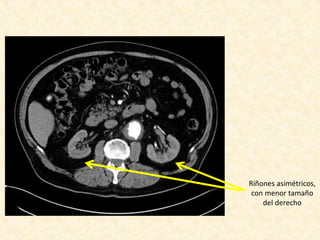 Riñones asimétricos,
con menor tamaño
del derecho
 