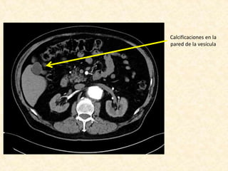 Calcificaciones en la
pared de la vesícula
 
