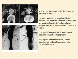 a) Proximalmente la prótesis (flechas) toca la
pared de la aorta.
b) Hacia caudal hay un endoleak (flechas
abiertas) con una base amplia en contacto con
las ramas de la prótesis (flechas sólidas).
Margen de la aorta está trombosado. Endoleak
tipo A.
c) Angiografía del mismo paciente. Hay un
pequeño perigraft leakage (flechas)
d) Luego de una embolización. Oclusión
completa del endoleak, con varios coils
metálicos (flechas)
 