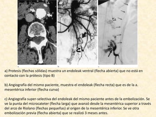 a) Protesis (flechas sólidas) muestra un endoleak ventral (flecha abierta) que no está en
contacto con la prótesis (tipo B)
b) Angiografía del mismo paciente, muestra el endoleak (flecha recta) que es de la a.
mesentérica inferior (flecha curva)
c) Angiografía super-selectiva del endoleak del mismo paciente antes de la embolización. Se
ve la punta del microcateter (flecha larga) que avanzó desde la mesentérica superior a través
del arco de Riolano (flechas pequeñas) al origen de la mesentérica inferior. Se ve otra
embolización previa (flecha abierta) que se realizó 3 meses antes.
 