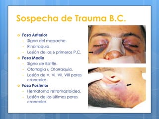 Sospecha de Trauma B.C.
   Fosa Anterior
    • Signo del mapache.
    • Rinorraquia.
    • Lesión de los 6 primeros P.C.
   Fosa Media
    • Signo de Battle.
    • Otorragia u Otorraquia.
    • Lesión de V, VI, VII, VIII pares
      craneales.
   Fosa Posterior
    • Hematoma retromastoideo.
    • Lesión de los últimos pares
      craneales.
 