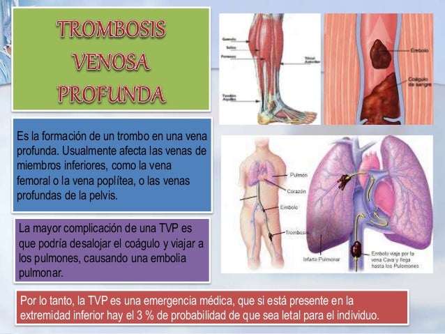 Como evitar de varikoza