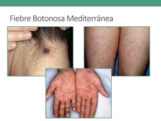 Fiebre Botonosa Mediterránea
 