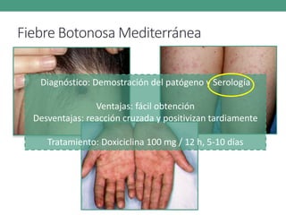 Fiebre Botonosa Mediterránea
Diagnóstico: Demostración del patógeno y Serología
Ventajas: fácil obtención
Desventajas: reacción cruzada y positivizan tardiamente
Tratamiento: Doxiciclina 100 mg / 12 h, 5-10 días
 