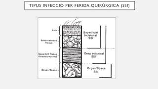 TIPUS INFECCIÓ PER FERIDA QUIRÚRGICA (SSI)
 