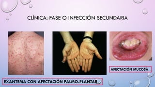 CLÍNICA: FASE O INFECCIÓN SECUNDARIA
EXANTEMA CON AFECTACIÓN PALMO-PLANTAR
AFECTACIÓN MUCOSA
 