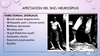 AFECTACIÓN DEL SNC: NEUROSÍFILIS
TABES DORSAL (DORSALIS)
- Dorsal column degeneration
- Orthopedic pain ( charcot joints)
- Reflexes decreased
- Shooting pain
- Argyll-Robertson pupils
- Locomotor ataxia
- Imparied propioception
- Syphilis
 