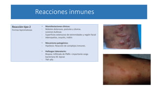 Reacciones inmunes
Reacción tipo 2
Formas lepromatosas
• Manisfestaciones clínicas:
- Nódulos dolorosos, pústulas y úlceras.
- Lesiones bullosas
- Superficies extensoras de extremidades y región facial
- Adenopatías, orquitis, iriditis
• Mecanismo patogénico:
- Hipótesis: Reacción de complejos inmunes.
• Hallazgos laboratorio:
- Biopsia: Infiltrado de PMN + importante carga
bacteriana M. leprae
- TNF-alfa
 
