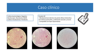 Caso clínico
Estudio AP:
- Micobacteriosis dérmica de patrón difuso histiocítico
con extensa paniculitis, y afectación vascular y neural.
- Compatible con lepra lepromatosa
Cultivo bacteriológico: Negativo.
Baciloscopia: Abundantes BAAR.
Cultivo micobacterias: Pendiente.
 