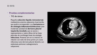 El 10/10:
• Pruebas complementarias:
• TC de tórax :
Pequeña colección líquida retroesternal,
mediastínica anterior, adyacente al pericardio,
que podría corresponder a un hematoma o
de etiología inflamatoria/infecciosa Leve-
moderada cantidad de derrame pleural
izquierdo, loculado, que se asocia a
engrosamiento y realce difuso de las hojas
pleurales de morfología lineal, de etiología
infecciosa. Presenta aire en su interior, en
relación con tubo de tórax previo y/o causa
infecciosa. Leve derrame pleural derecho con
atelectasia pulmonar subsegmentaria
subyacente.
 