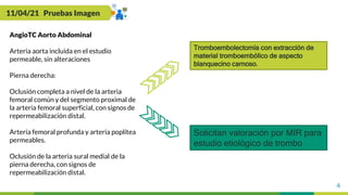 4
11/04/21 Pruebas Imagen
AngioTC Aorto Abdominal
Arteria aorta incluida en el estudio
permeable, sin alteraciones
Pierna derecha:
Oclusión completa a nivel de la arteria
femoral común y del segmento proximal de
la arteria femoral superficial, con signos de
repermeabilización distal.
Arteria femoral profunda y arteria poplítea
permeables.
Oclusión de la arteria sural medial de la
pierna derecha, con signos de
repermeabilización distal.
Tromboembolectomía con extracción de
material tromboembólico de aspecto
blanquecino carnoso.
Solicitan valoración por MIR para
estudio etiológico de trombo
 