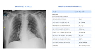 RADIOGRAFÍA DE TÓRAX: ARTROCENTESIS RODILLA DERECHA:
 