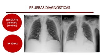PRUEBAS DIAGNÓSTICAS
RX TÓRAX
SEDIMENTO
URINARIO
(anodino)
 