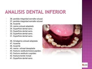 

















38. perdida integridad esmalte oclusal.
37. perdida integridad esmalte oclusal
36. Ausente
35. resina oclusal adaptado
34. Superficie dental sano.
33. Superficie dental sano.
32. Superficie dental sano.
31. Superficie dental sano.
48. Amalgama oclusal adaptada
47. Ausente
46. Ausente
45. resina oclusal desaptada
44. fractura vestibulomesiocuspideo.
43. fractura vestibulo cuspideo
42. fractura borde incisal .
41. Superficie dental sano.

 