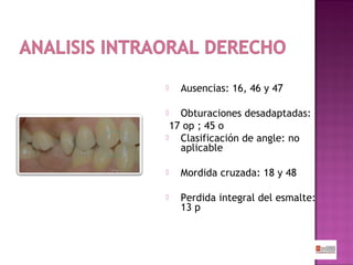 

Ausencias: 16, 46 y 47

Obturaciones desadaptadas:
17 op ; 45 o

Clasificación de angle: no
aplicable




Mordida cruzada: 18 y 48



Perdida integral del esmalte:
13 p

 