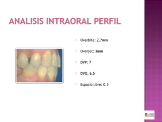 

Overbite: 2.7mm



Overjet: 3mm



DVP: 7



DVO: 6.5



Espacio libre: 0.5

 